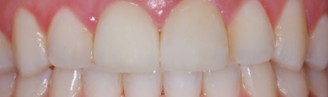 dental implant houston tx