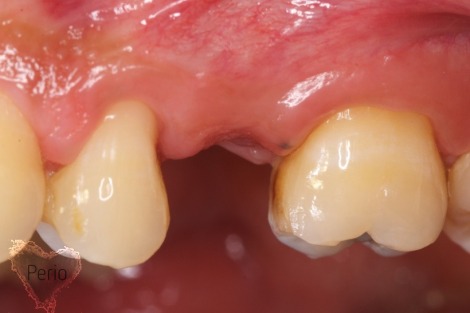 dental implants and sinus lift houston tx before