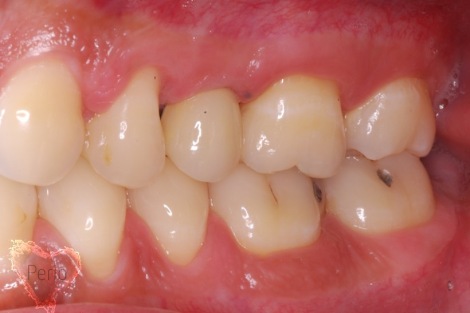 dental implants sinus lift houston tx after