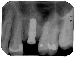 dental implants sinus lift houston tx