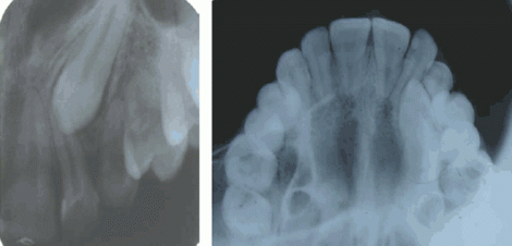Occlusal radiographs with lateral (left) and orthogonal (right) projections
