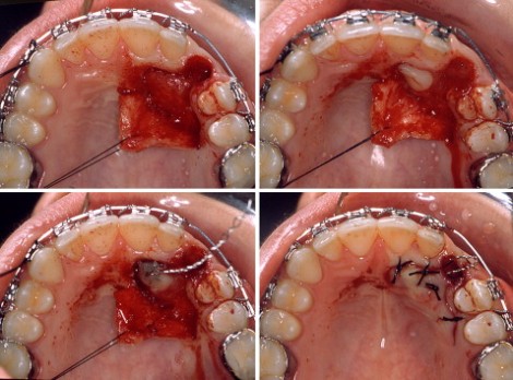 canine exposure palatal approach