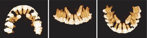 Three dimensional reconstructed image (CBCT) of impacted maxillary canines