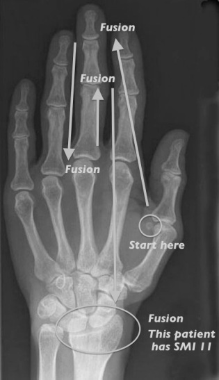Hand-wrist radiograph of adult