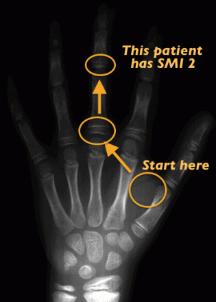 Hand-wrist radiograph of child