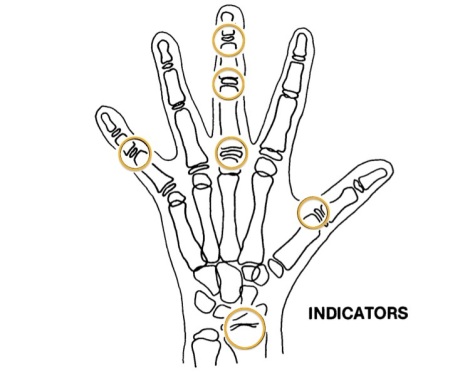 Sites of Skeletal Maturity Indicators