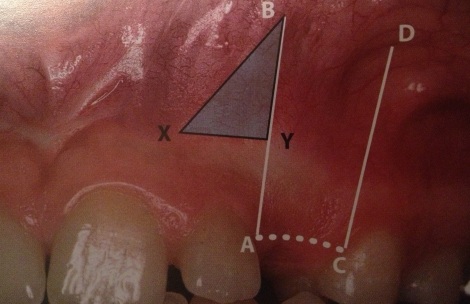 Laterally position apically displaced flap