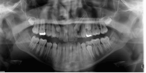 Panoramic Radiograph Showing Maxillary Impacted Canines
