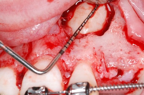 Surgical Exposure Impacted Tooth