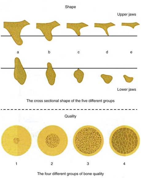 Lekholm & Zarb Bone Classification 1985