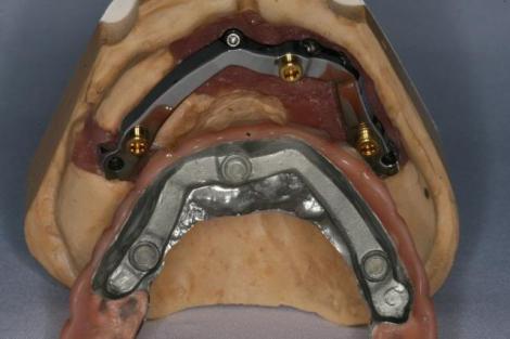 Implant-supported complete denture bar side