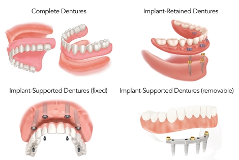 options for patient with no teeth