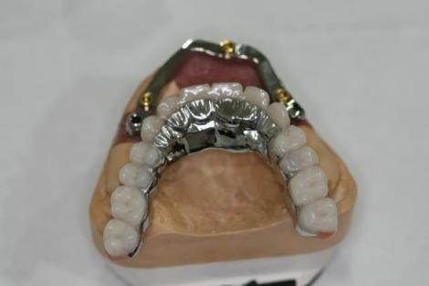 Implant-supported complete denture